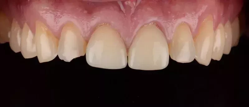 ตัวอย่างฟันของผู้ใช้บริการรายหนึ่งก่อนรับบริการเคลือบผิวหน้าฟันวีเนียร์
