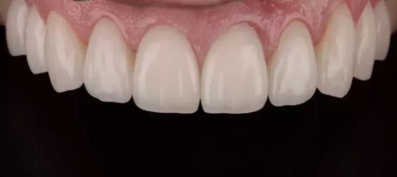 ตัวอย่างฟันของผู้ใช้บริการรายหลังรับบริการเคลือบผิวหน้าฟันวีเนียร์