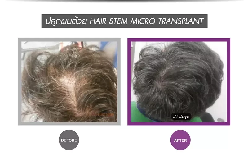 Before After ปลูกผมแบบ Hair stem micro transplant ที่ APEX Medical Center