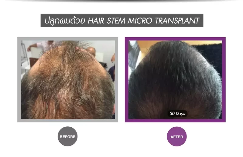 Before After ปลูกผมแบบ Hair stem micro transplant ที่ APEX Medical Center