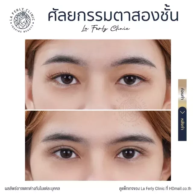 รีวิว ทำตาสองชั้น ที่ La Ferly Clinic