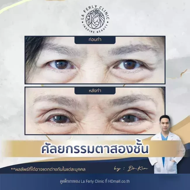 รีวิว ทำตาสองชั้น ที่ La Ferly Clinic