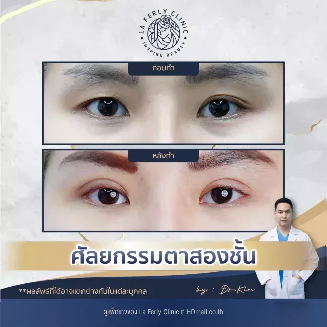 รีวิว ทำตาสองชั้น ที่ La Ferly Clinic