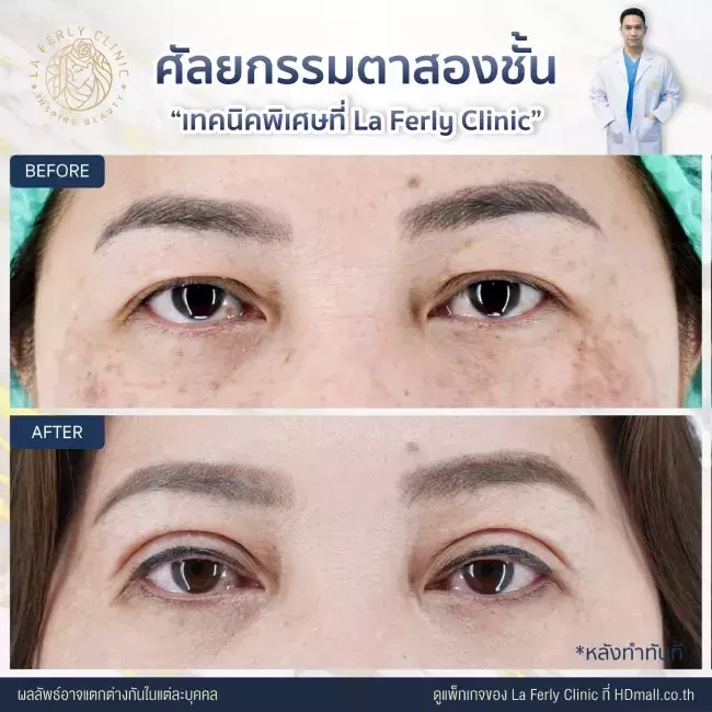 รีวิว ทำตาสองชั้น ที่ La Ferly Clinic