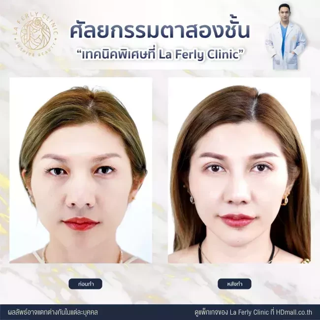 รีวิว ทำตาสองชั้น ที่ La Ferly Clinic