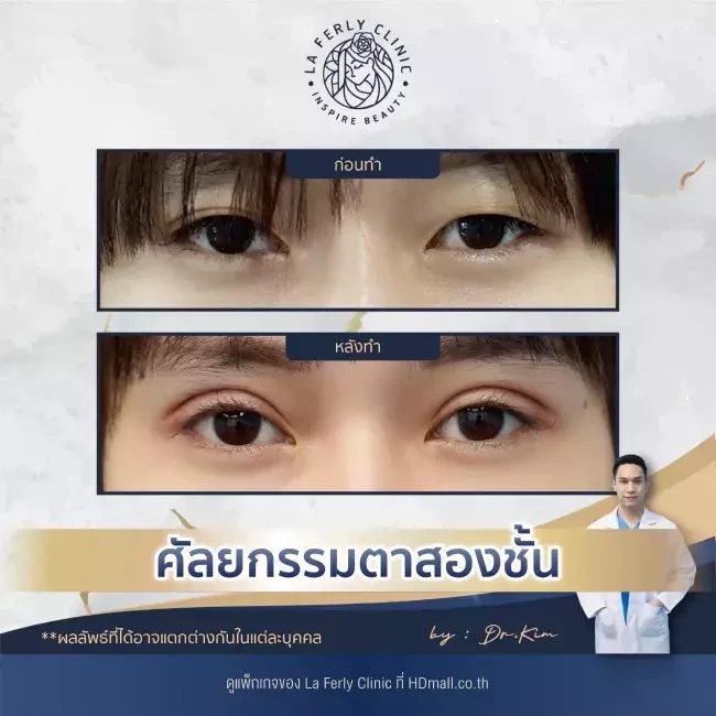 รีวิว ทำตาสองชั้น ที่ La Ferly Clinic