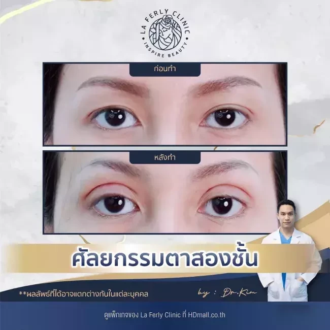 รีวิว ทำตาสองชั้น ที่ La Ferly Clinic