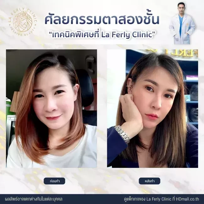 รีวิว ทำตาสองชั้น ที่ La Ferly Clinic