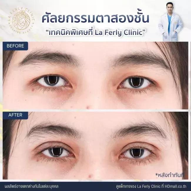 รีวิว ทำตาสองชั้น ที่ La Ferly Clinic