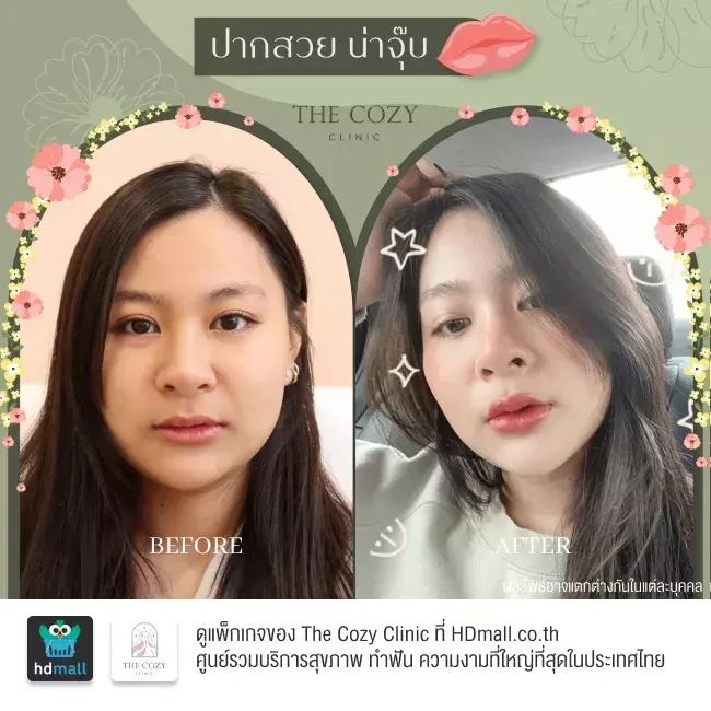 รีวิว ฉีดฟิลเลอร์ ที่ The Cozy Clinic