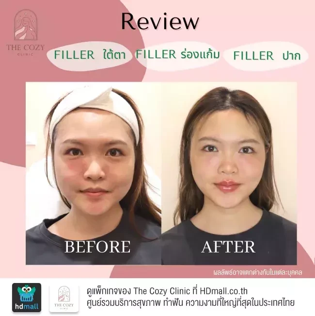 รีวิว ฉีดฟิลเลอร์ ที่ The Cozy Clinic