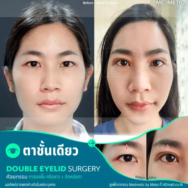 รีวิว ทำตา ผ่าตัดตกแต่งหนังตาบน ที่ Medmetic by Meko