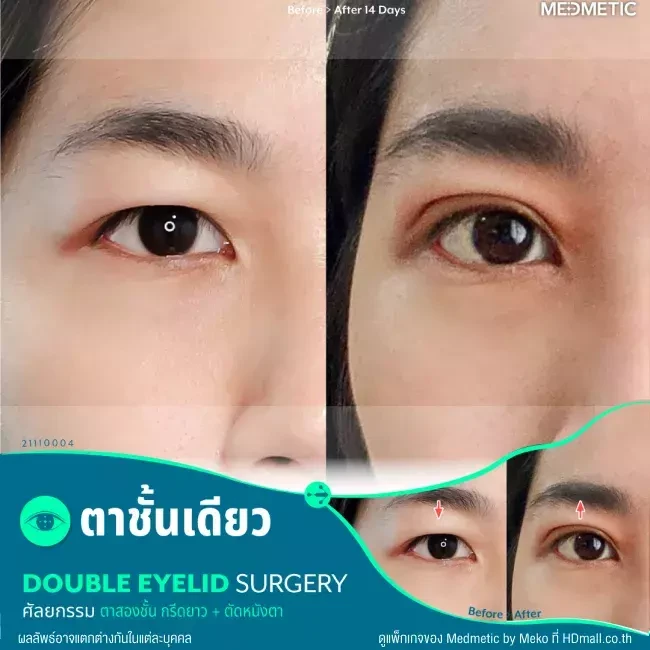 รีวิว ทำตา ผ่าตัดตกแต่งหนังตาบน ที่ Medmetic by Meko