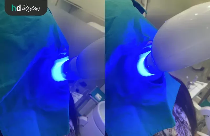 ขั้นตอนการฟอกสีฟัน ด้วยระบบ Cool Light ที่ The ARCH Dental Center