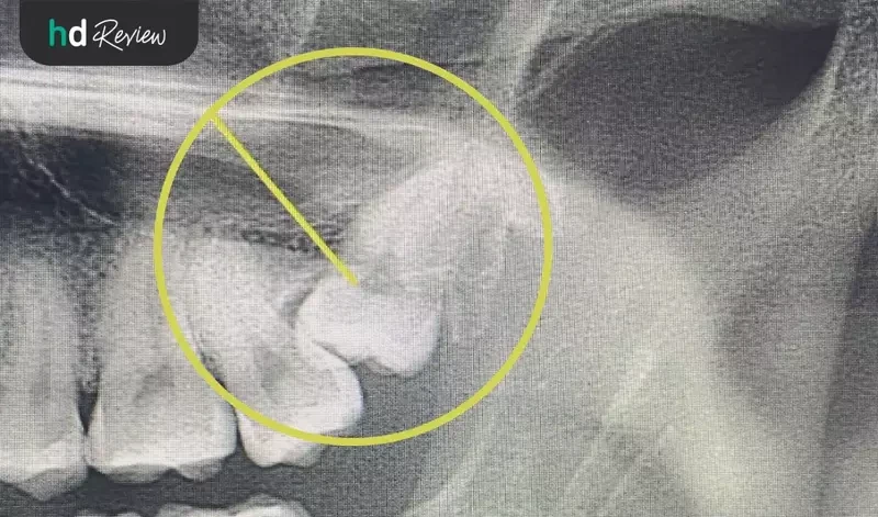 ภาพผ่าฟันคุด หลังจากเอกซเรย์