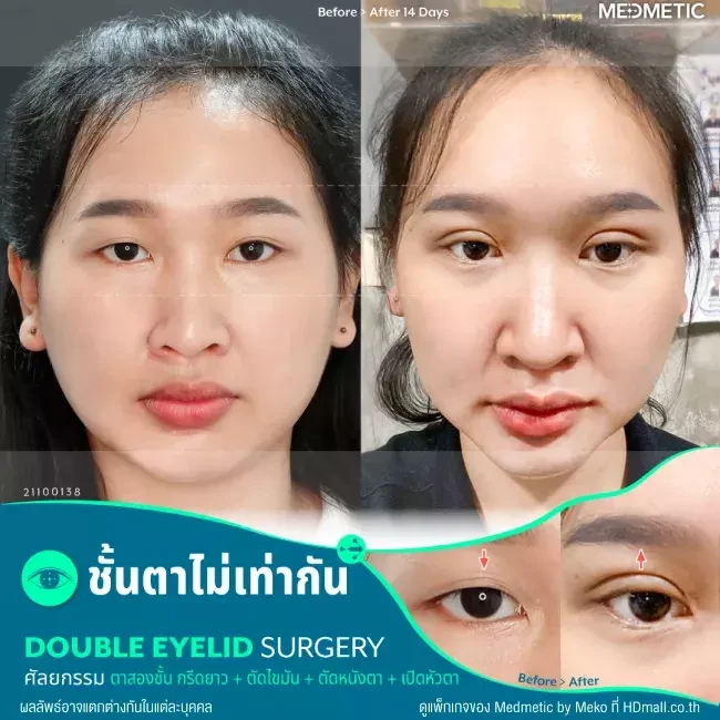 รีวิว ทำตาสองชั้น จัดเรียงไขมันใต้ตาบน ที่ Medmetic by Meko