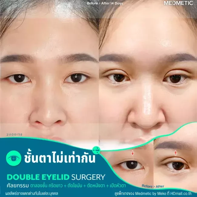 รีวิว ทำตาสองชั้น จัดเรียงไขมันใต้ตาบน ที่ Medmetic by Meko