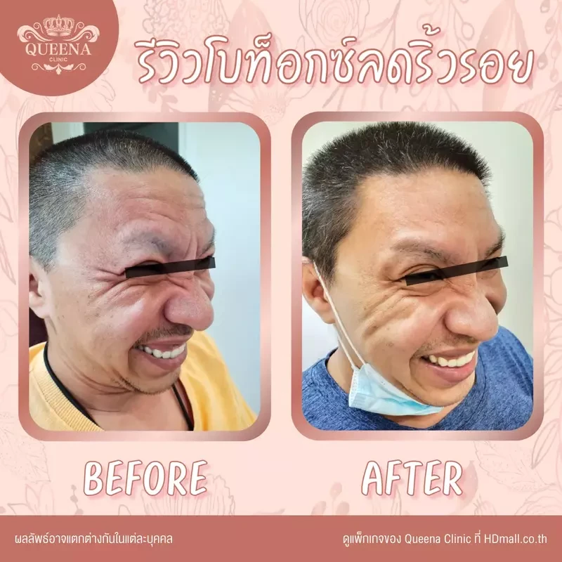 รีวิว ฉีดโบท็อกซ์ ที่ Queena Clinic