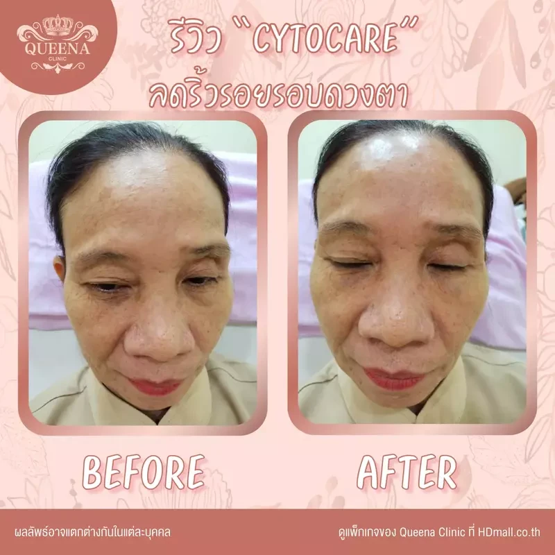 รีวิว ฉีด Cytocare ที่ Queena Clinic