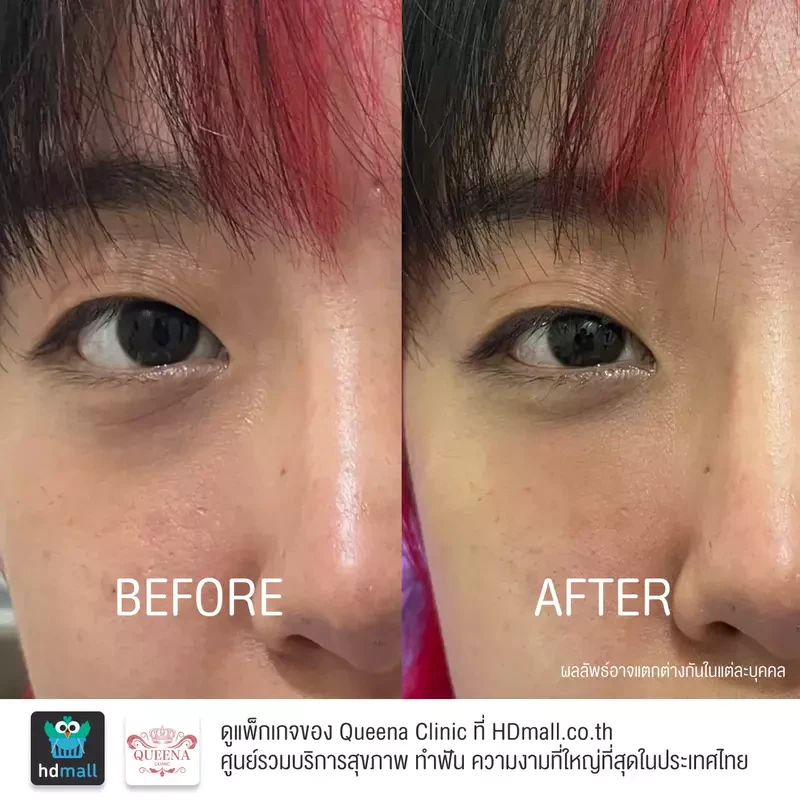 รีวิว ฉีด Cytocare ที่ Queena Clinic