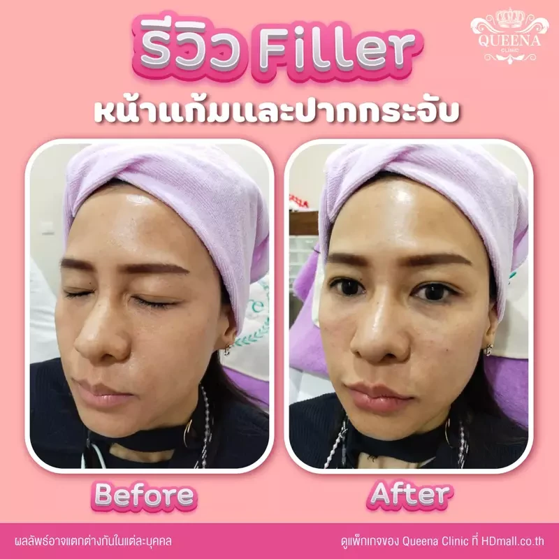 รีวิว ฉีดฟิลเลอร์ ที่ Queena Clinic