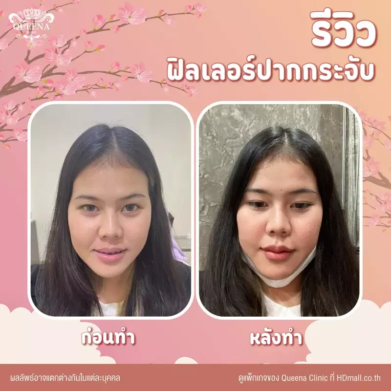 รีวิว ฉีดฟิลเลอร์ ที่ Queena Clinic