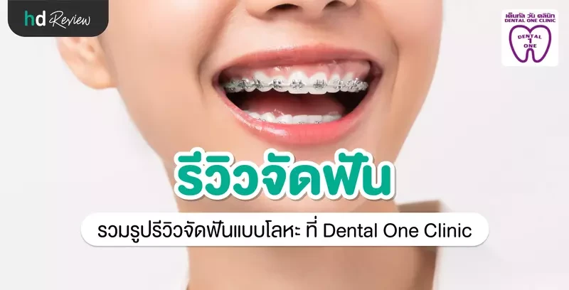 รีวิว จัดฟันแบบโลหะ ที่ Dental One Clinic