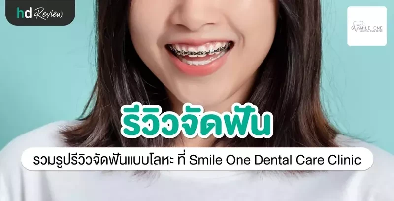 รีวิว จัดฟันแบบโลหะ ที่ Smile One Dental Care Clinic