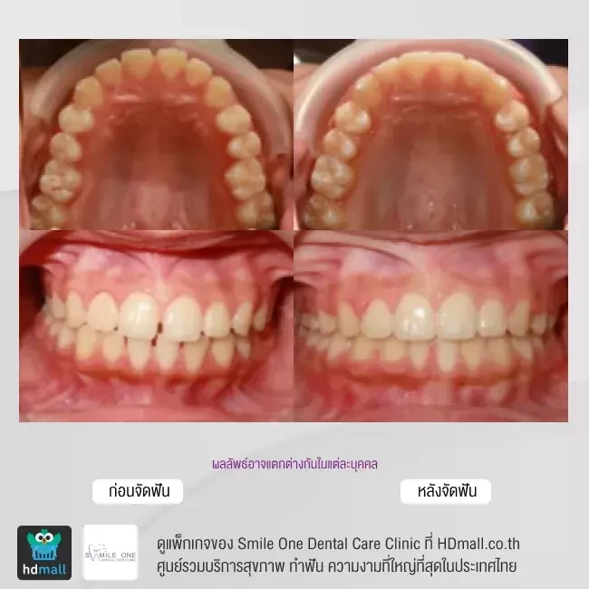 รีวิว จัดฟันแบบโลหะ ที่ Smile One Dental Care Clinic