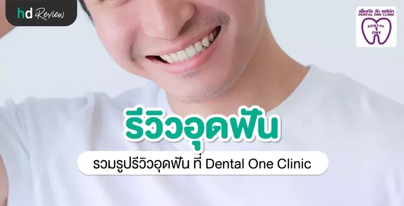 รีวิว อุดฟัน ที่ Dental One Clinic