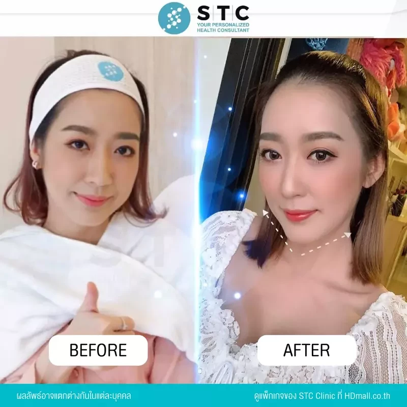 รีวิว ฉีดโบท็อกซ์ ที่ STC Clinic