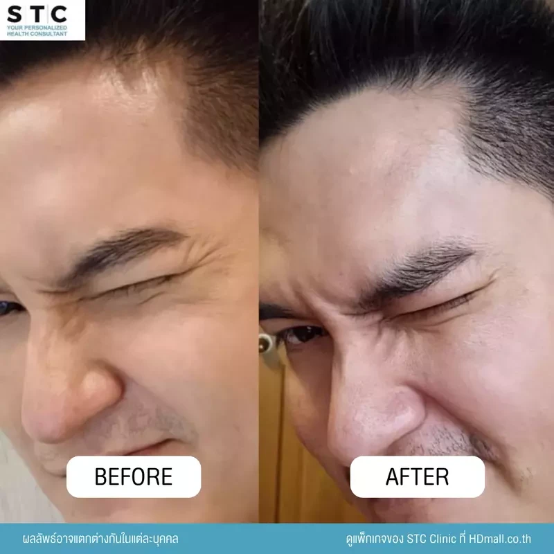 รีวิว ฉีดโบท็อกซ์ ที่ STC Clinic