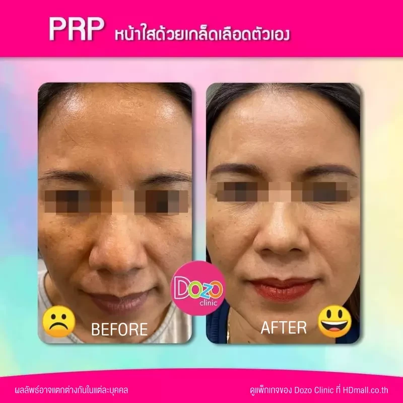 รีวิว ฉีด PRP บำรุงผิวหน้า ที่ Dozo Clinic