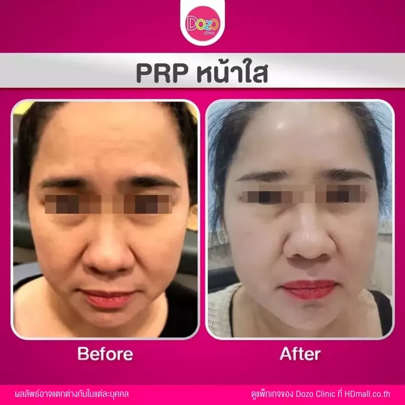 รีวิว ฉีด PRP บำรุงผิวหน้า ที่ Dozo Clinic