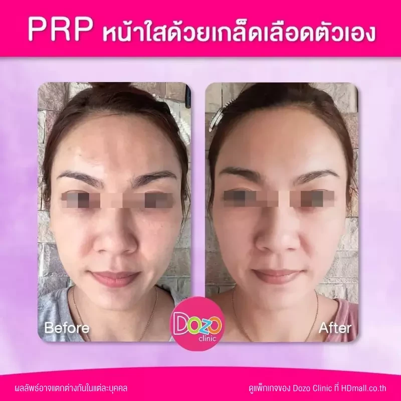 รีวิว ฉีด PRP บำรุงผิวหน้า ที่ Dozo Clinic