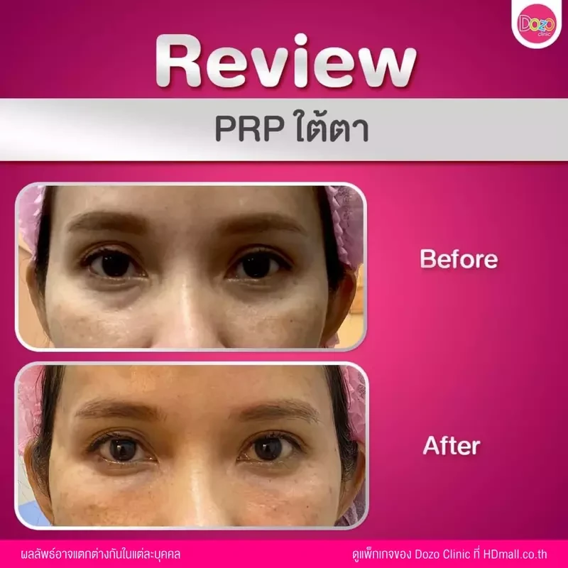 รีวิว ฉีด PRP บริเวณใต้ตา ที่ Dozo Clinic