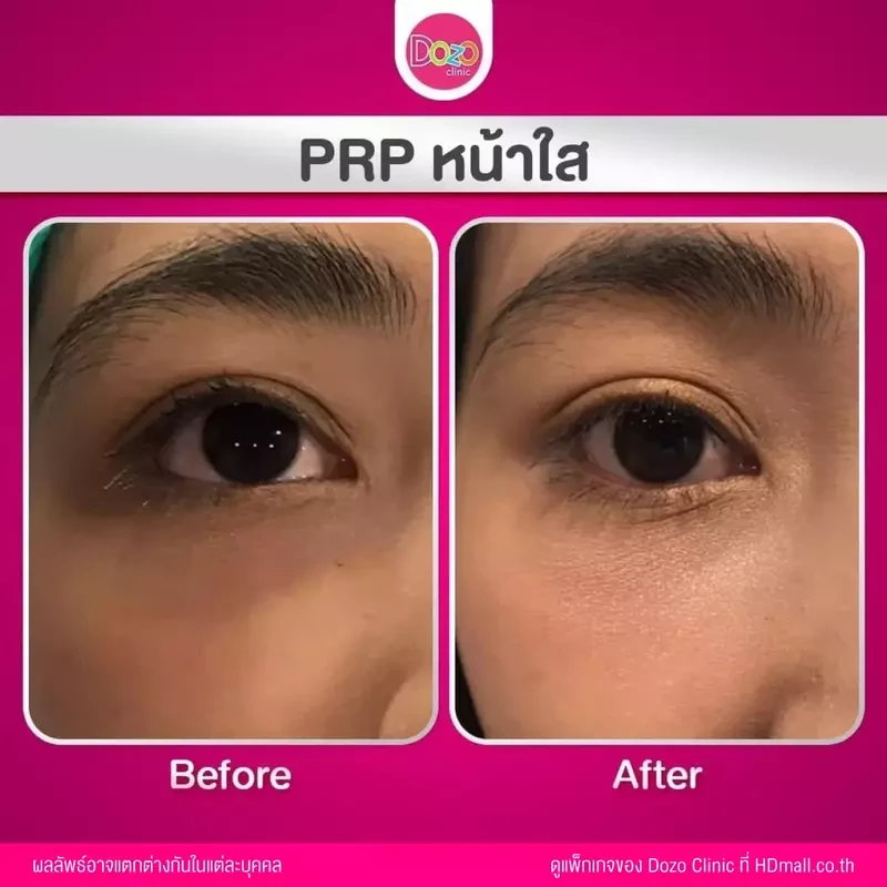 รีวิว ฉีด PRP บริเวณใต้ตา ที่ Dozo Clinic