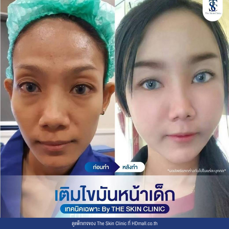 รีวิว เติมไขมันหน้า (ALMI Nano Fat) ที่ The Skin Clinic