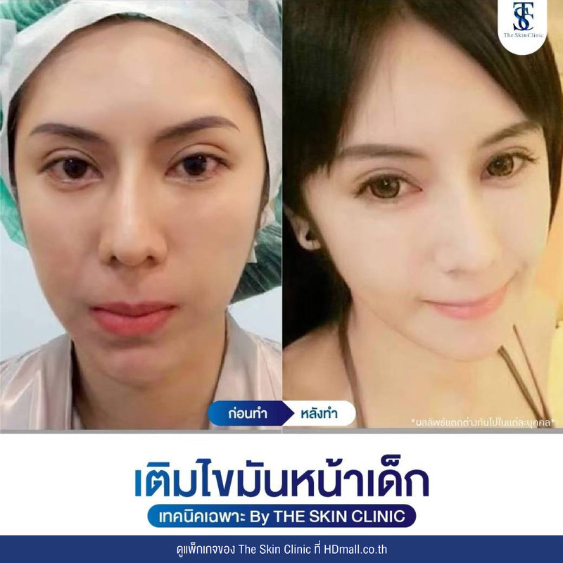 รีวิว เติมไขมันหน้า (ALMI Nano Fat) ที่ The Skin Clinic