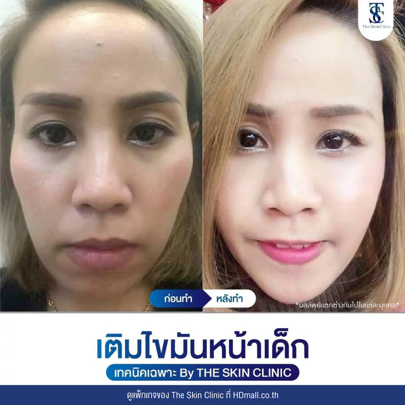 รีวิว เติมไขมันหน้า (ALMI Nano Fat) ที่ The Skin Clinic