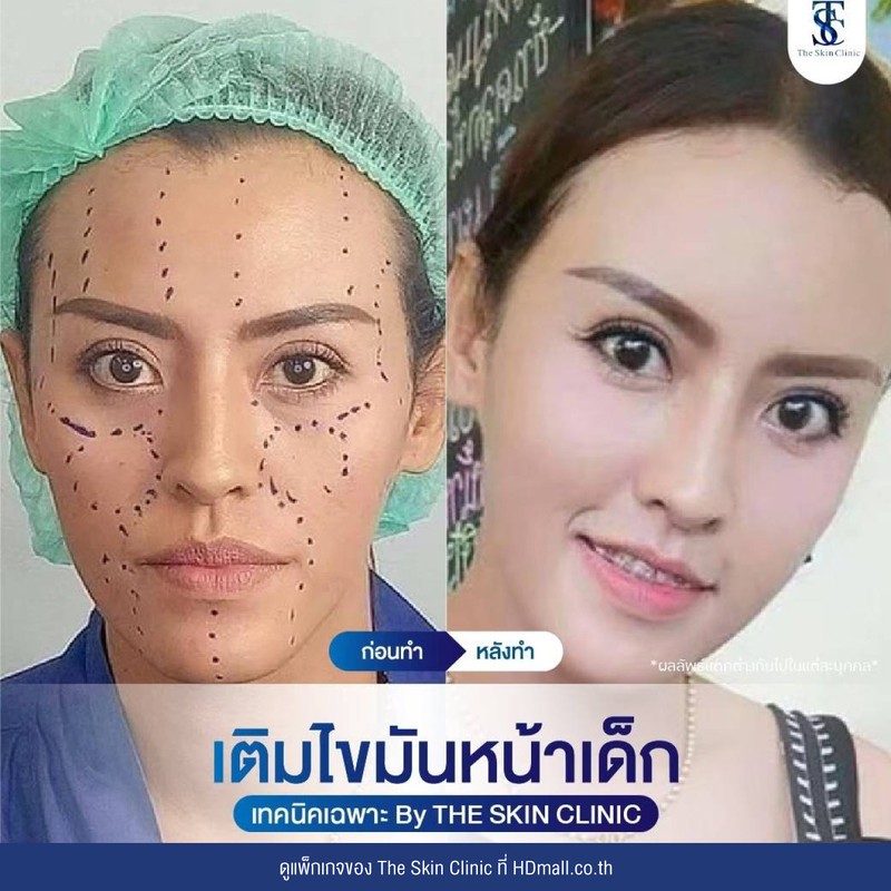 รีวิว เติมไขมันหน้า (ALMI Nano Fat) ที่ The Skin Clinic