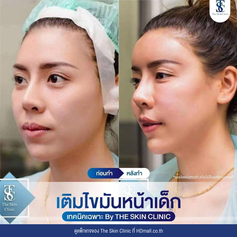 รีวิว เติมไขมันหน้า (ALMI Nano Fat) ที่ The Skin Clinic