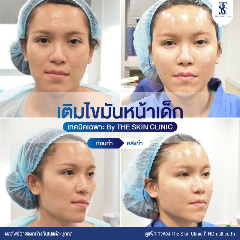 รีวิว เติมไขมันหน้า (ALMI Nano Fat) ที่ The Skin Clinic