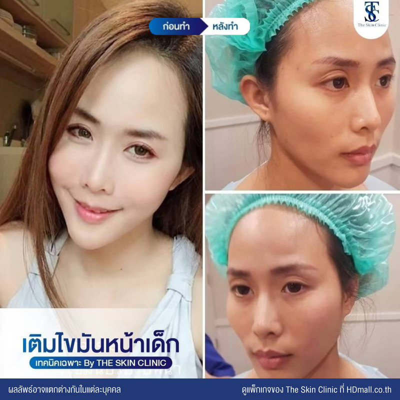 รีวิว เติมไขมันหน้า (ALMI Nano Fat) ที่ The Skin Clinic