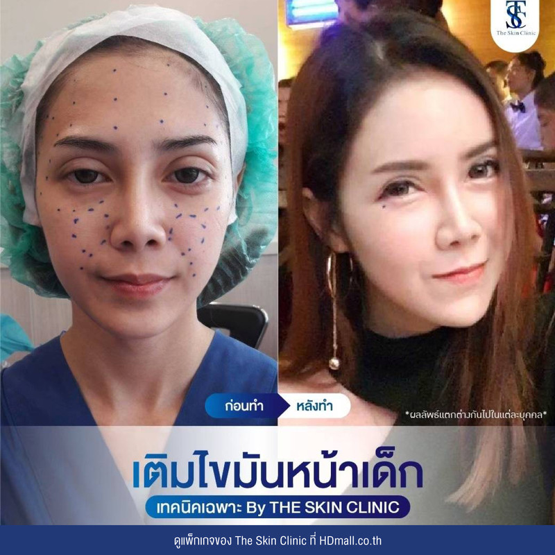 รีวิว เติมไขมันหน้า (ALMI Nano Fat) ที่ The Skin Clinic