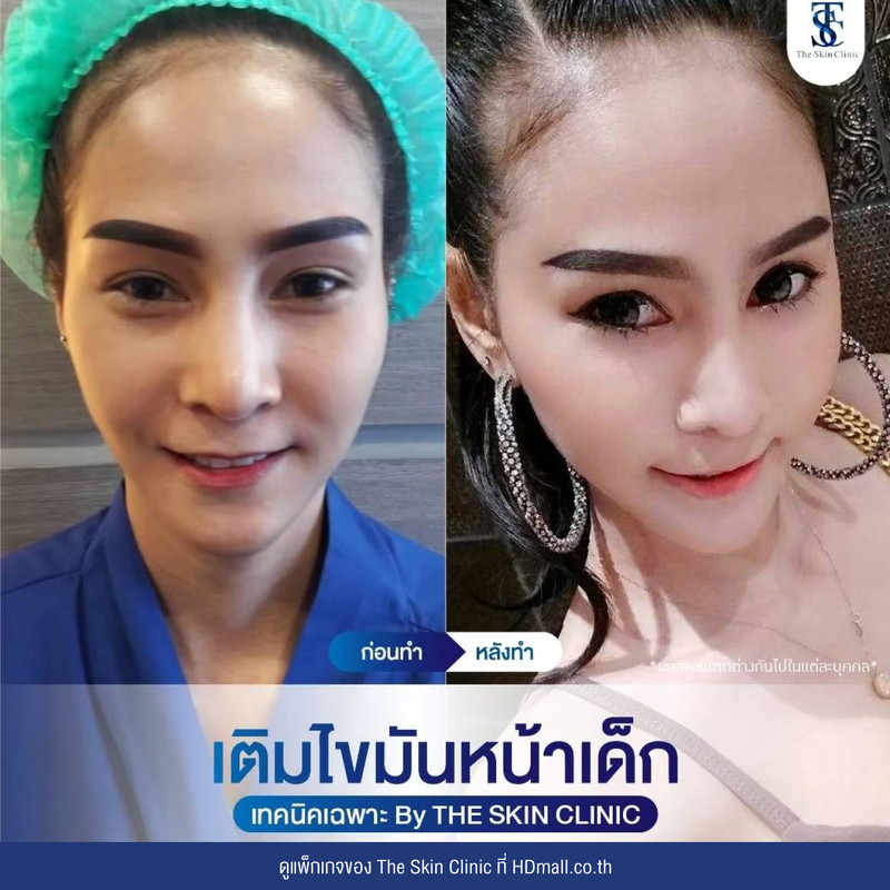 รีวิว เติมไขมันหน้า (ALMI Nano Fat) ที่ The Skin Clinic