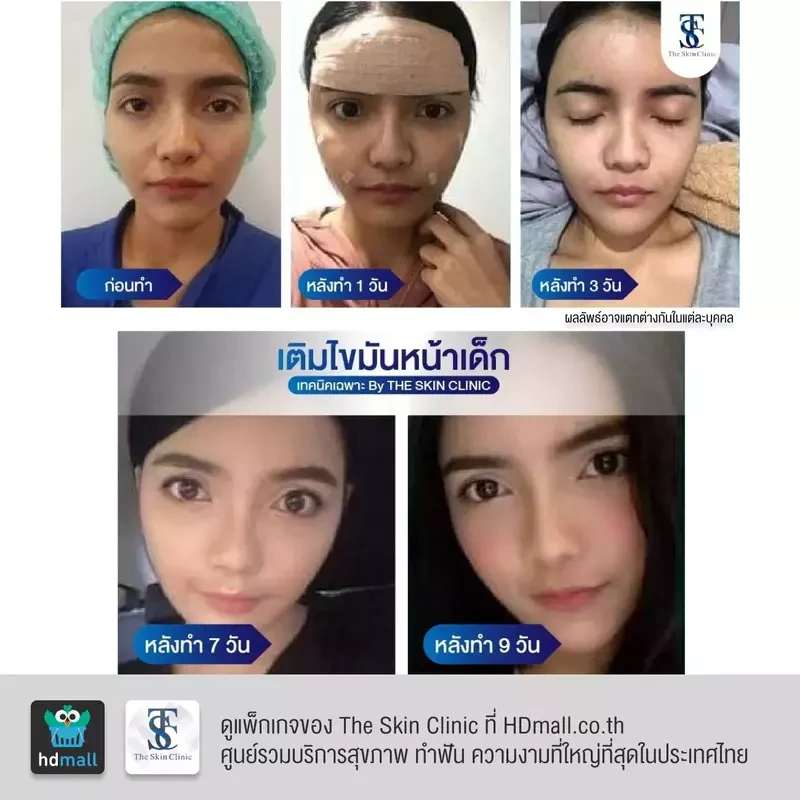 รีวิว เติมไขมันหน้า (ALMI Nano Fat) ที่ The Skin Clinic