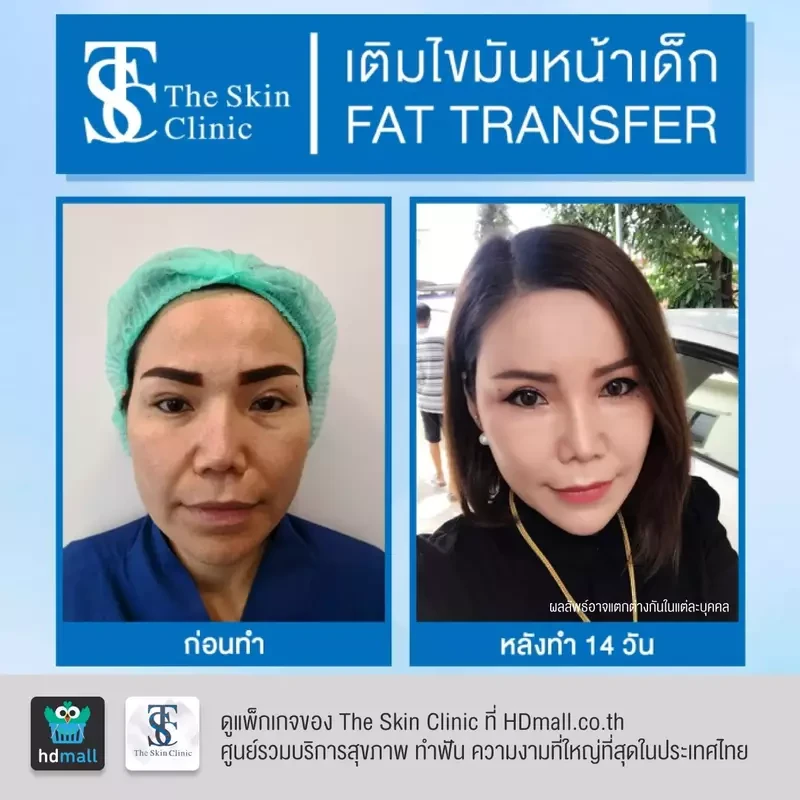 รีวิว เติมไขมันหน้า (ALMI Nano Fat) ที่ The Skin Clinic