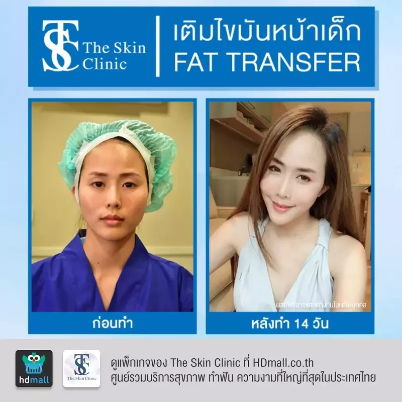 รีวิว เติมไขมันหน้า (ALMI Nano Fat) ที่ The Skin Clinic