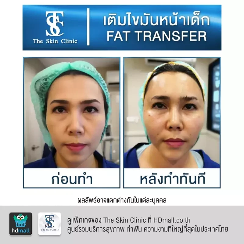 รีวิว เติมไขมันหน้า (ALMI Nano Fat) ที่ The Skin Clinic